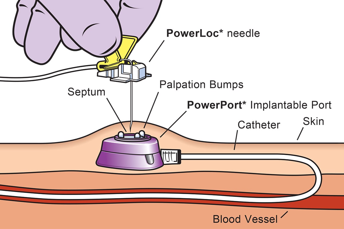 Portacath insertion Hagley Vascular (Dr Daniel Hagley)