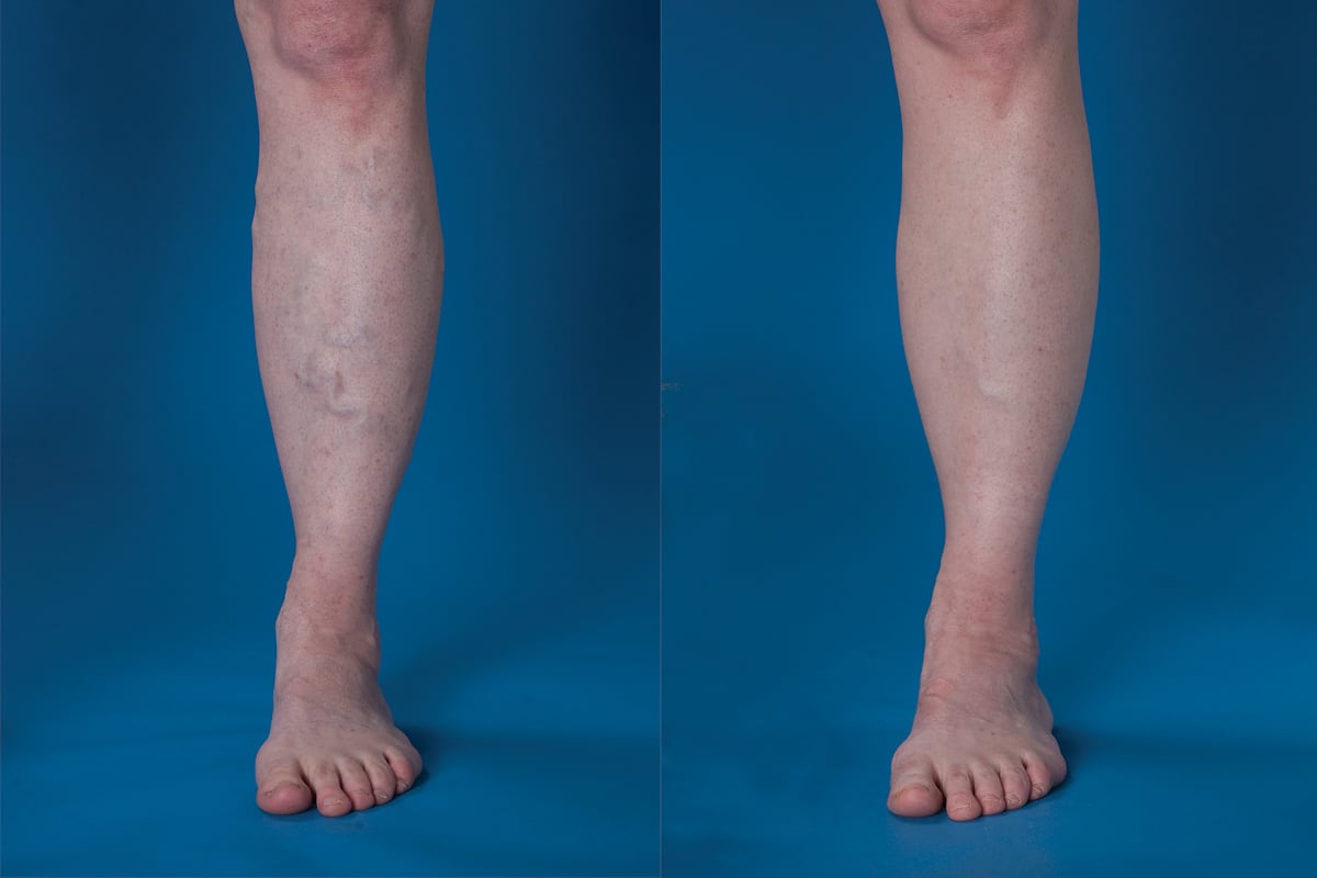 Causes Varicose veins are often hereditary, but are also common for women during pregnancy and they can also be caused by injury to the leg, spending a lot of time standing up, being overweight or not very mobile, or simply as part of the ageing process. 
